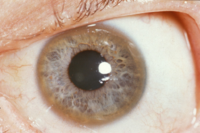 Photo showing a pale coper coloured Kayser-Fleischer ring around the edge of the coloured part of an eye.